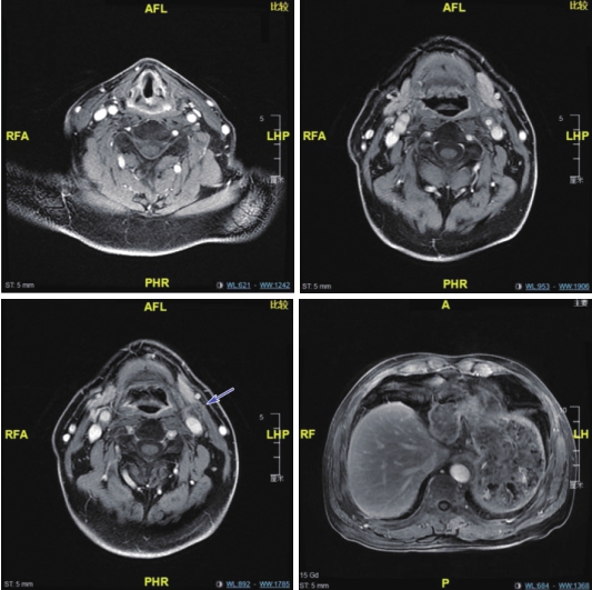 图4 喉MRI及腹部MRI（6疗程后）